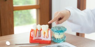 уградња-зубних -имплантата