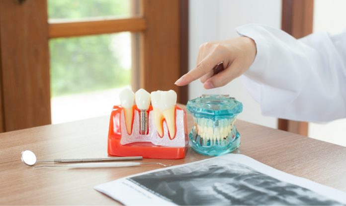 уградња-зубних -имплантата